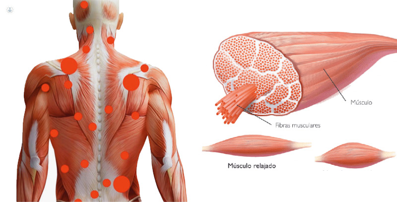 contractures