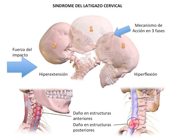 Latigazo cervical mecanismo lesional