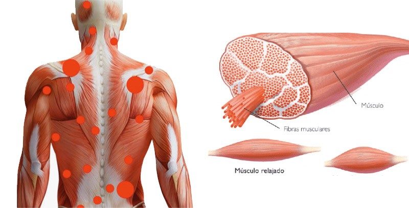 Contractura Muscular